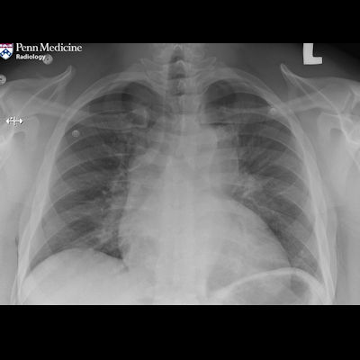 30-year-old man with acute chest pain