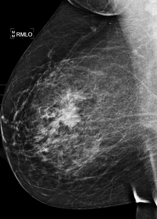 47-year-old woman with palpable breast mass