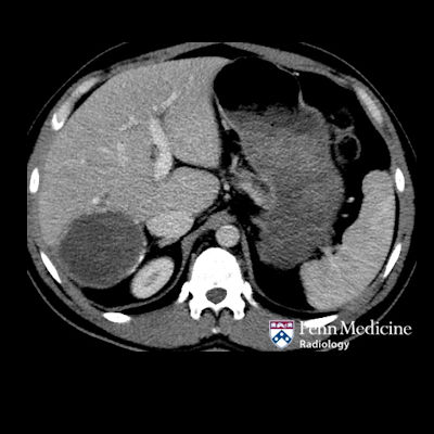 37-year-old man with abdominal pain