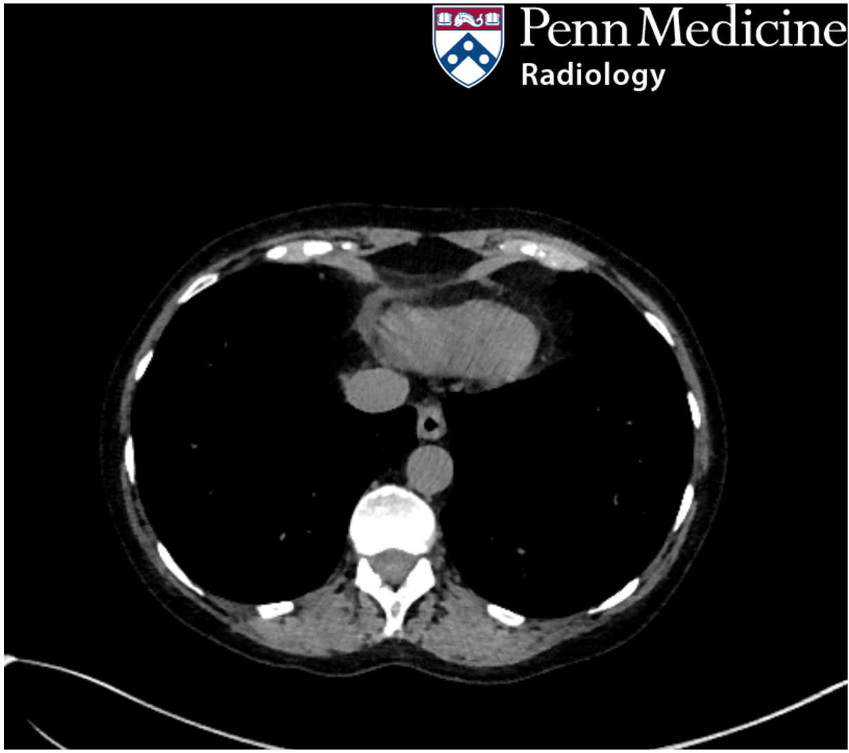 56-year-old woman with dysphagia