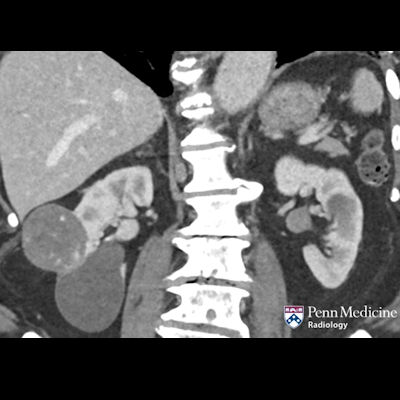 95-year-old man with incidental finding