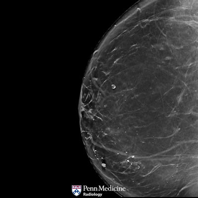 48-year-old woman undergoing annual mammogram