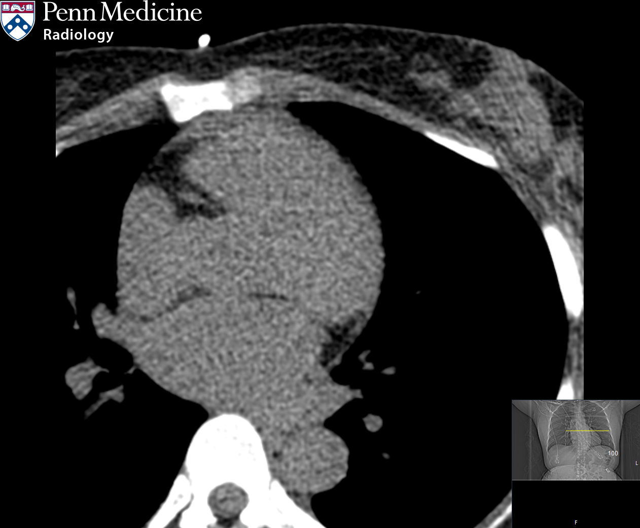 49-year-old woman with chest discomfort