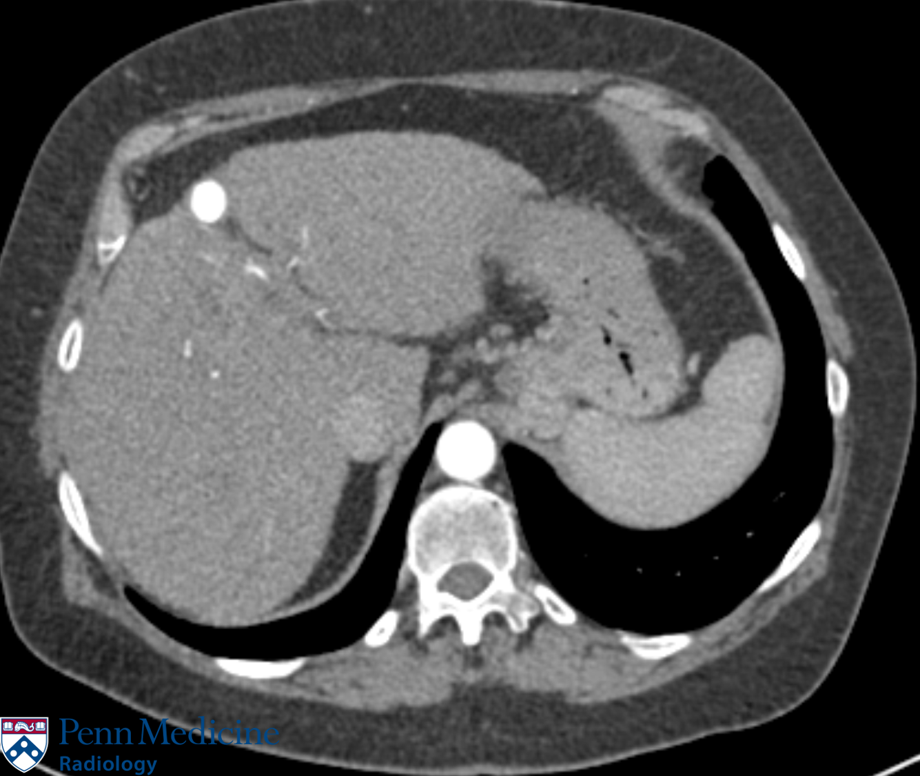 61-year-old woman with hepatocellular carcinoma