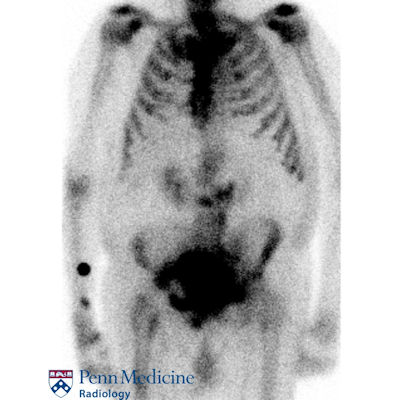 70-year-old man with prostate cancer