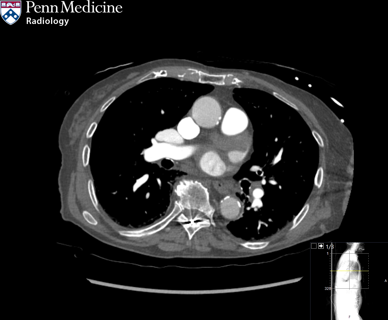 89-year-old woman with atrial fibrillation