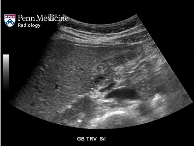 25-year-old woman with right upper abdominal pain