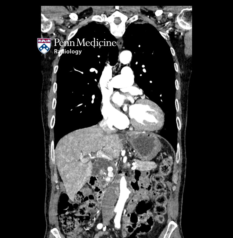 77-year-old man with acute-onset epigastric pain