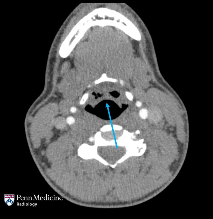 23-year-old man with acute neck pain