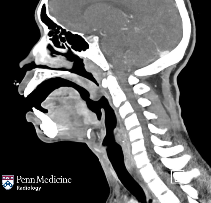 25-year-old man with dysphagia and severe chest, abdominal pain