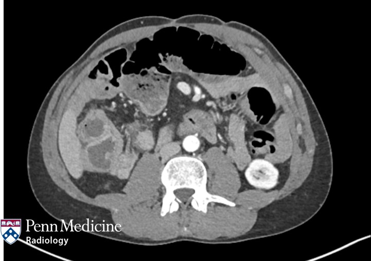 40-year-old man with abdominal pain
