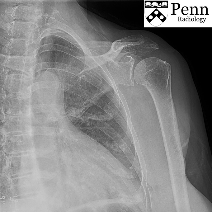 64-year-old woman with shoulder pain for 1 month