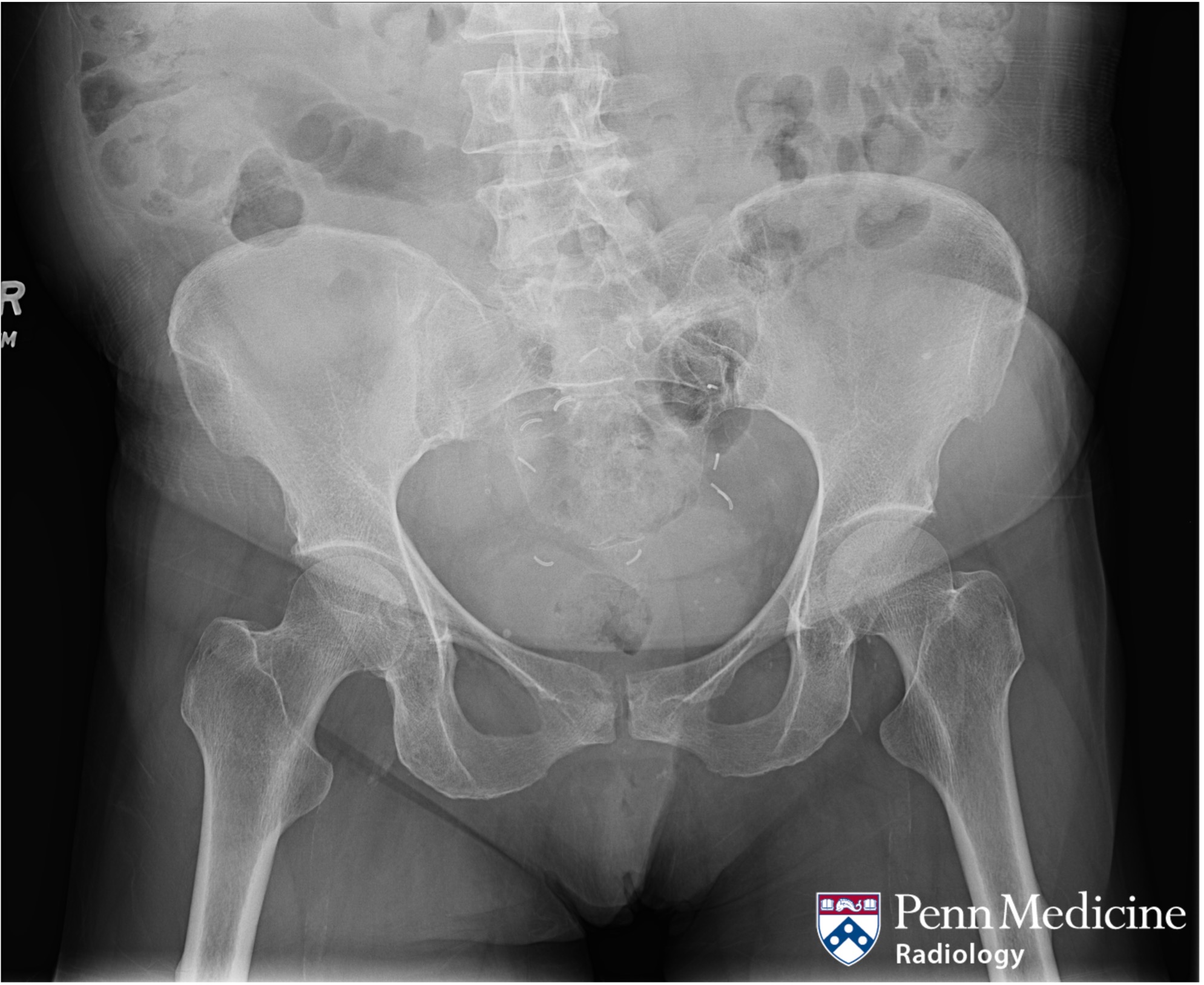 68-year-old woman with severe right hip pain