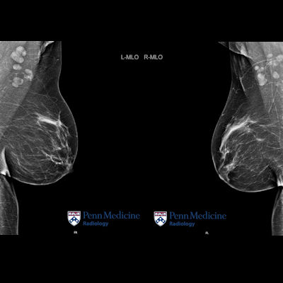 45-year-old woman with rheumatoid arthritis undergoing screening mammogram