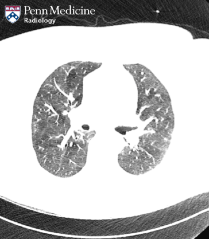 62-year-old woman with chronic dyspnea, cough