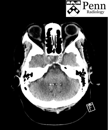 70-year-old woman with ptosis