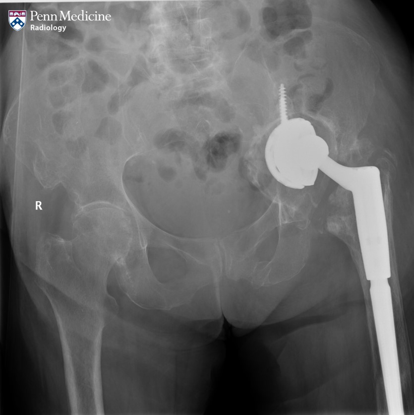 78-year-old woman after mechanical fall