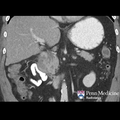 55-year-old woman with abdominal pain