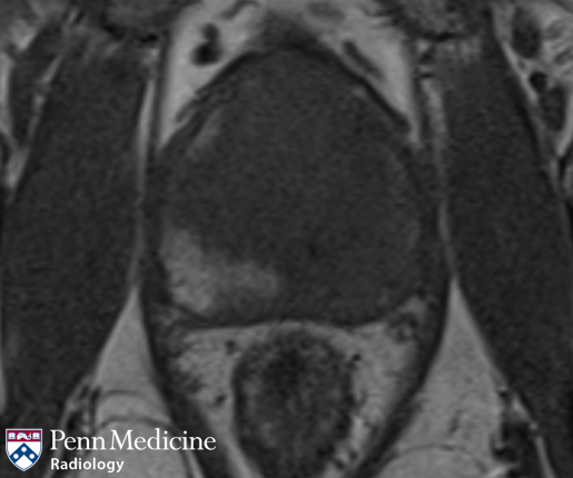 59-year-old man with elevated prostate-specific antigen level