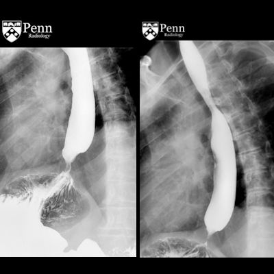59-year-old man with hiccups, early satiety, weight loss