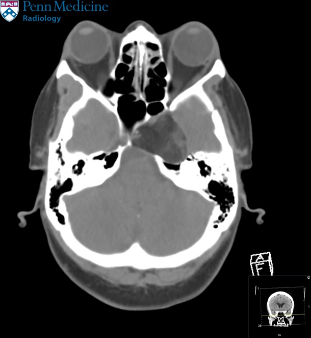 58-year-old woman with vomiting, fever