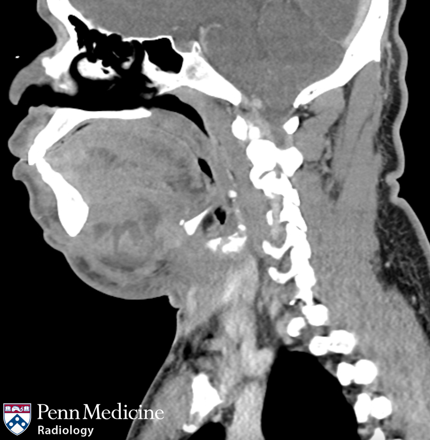 38-year-old man with jaw pain, swelling
