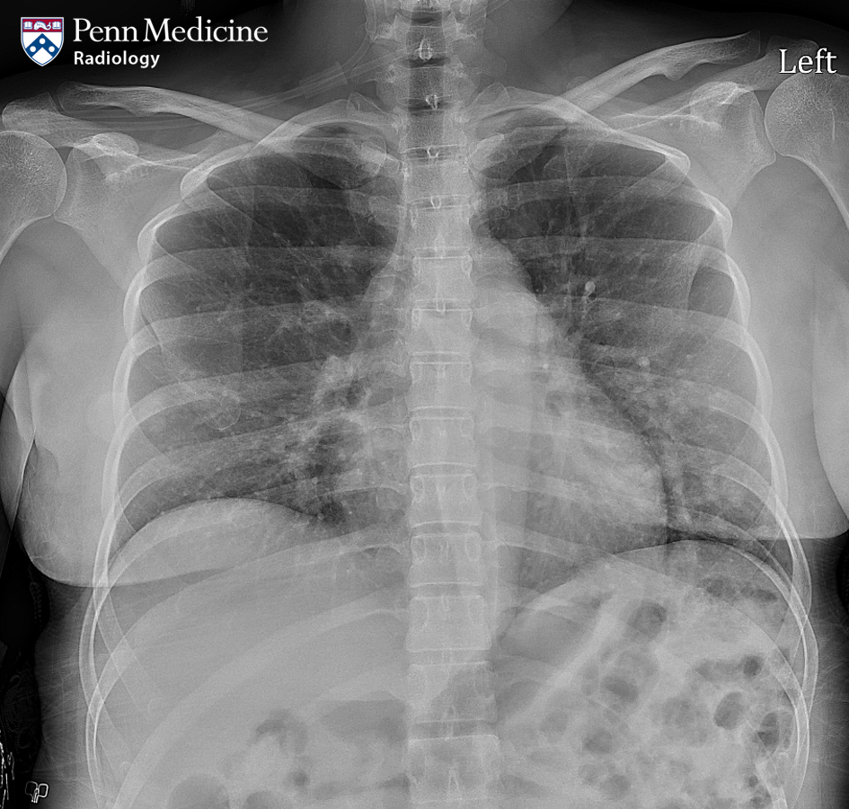 33-year-old woman with hypoxia