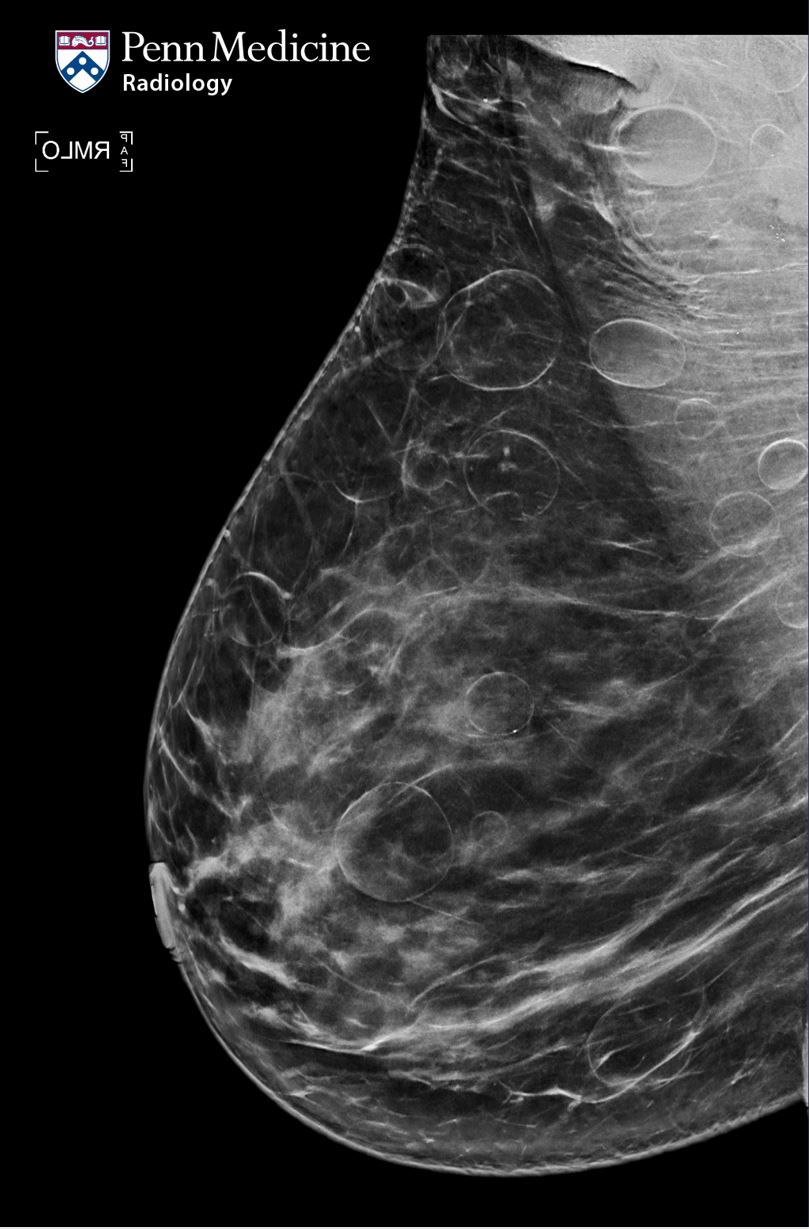 44-year-old woman undergoing screening mammography