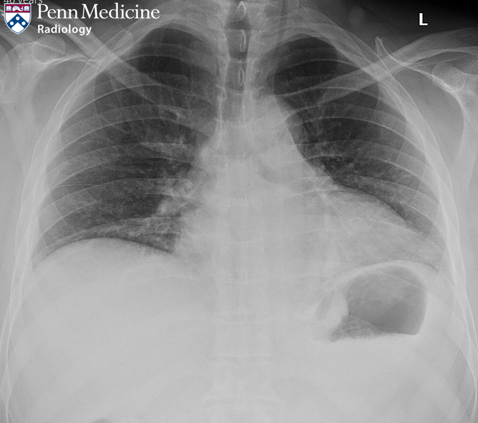 46-year-old man with substernal chest pain, dysphagia