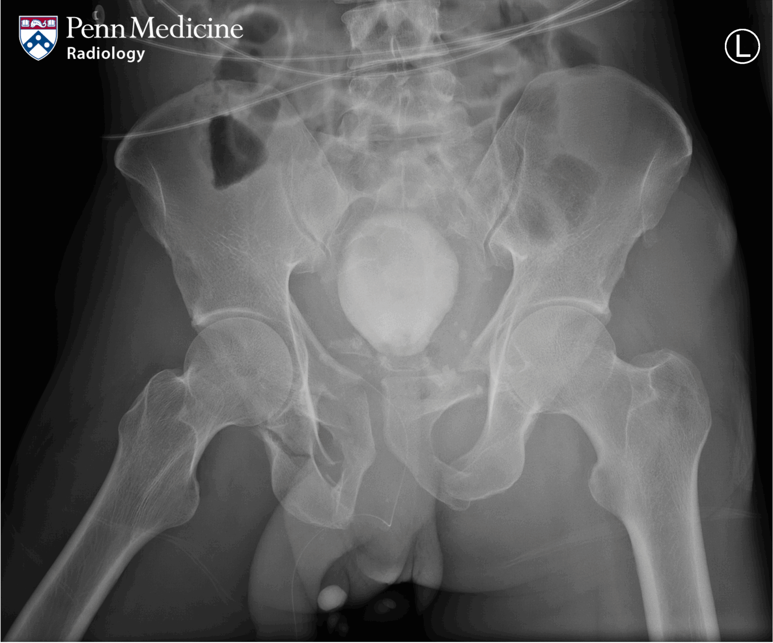 57-year-old man struck by motor vehicle