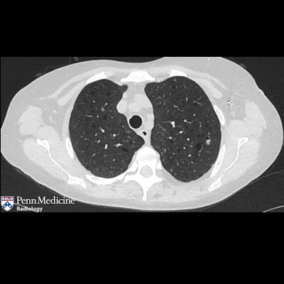 60-year-old woman with learning disabilities, seizures