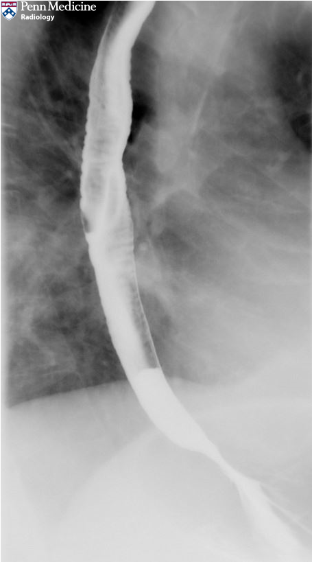 61-year-old man with globus sensation