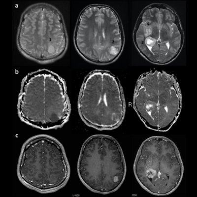 17-year-old boy with progressive headaches