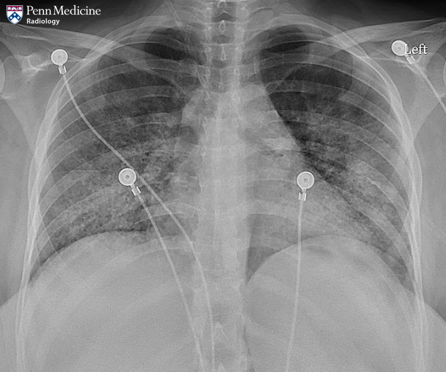 26-year-old woman with worsening shortness of breath