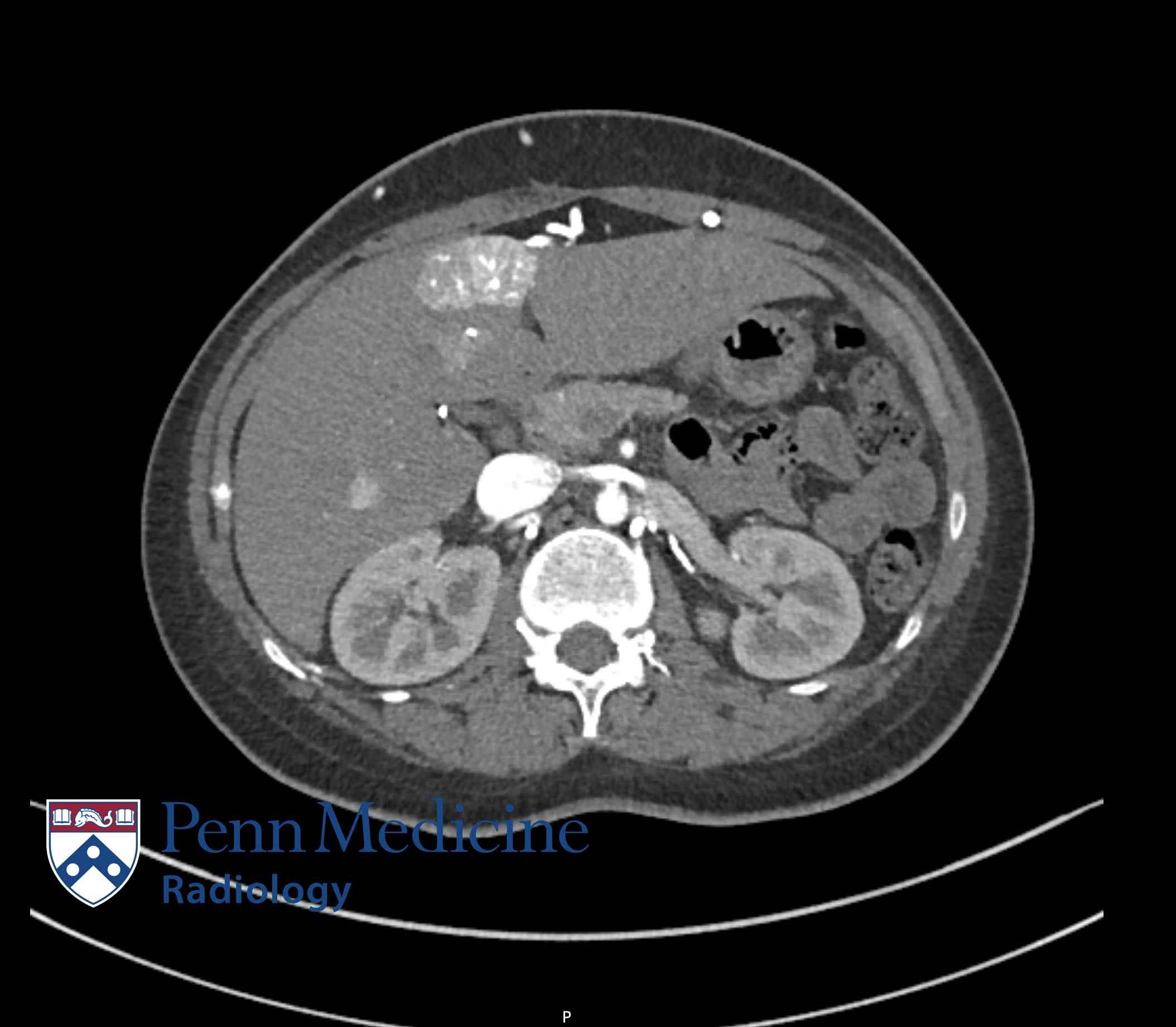 42-year-old man with sickle cell anemia, epigastric pain