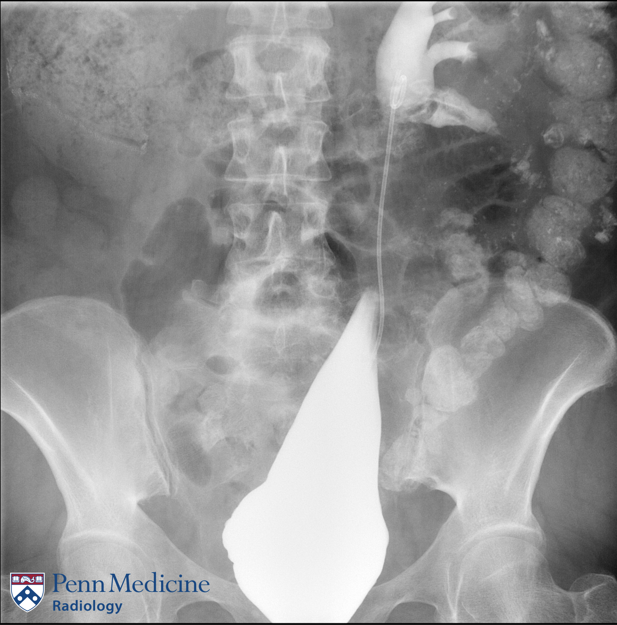 61-year-old woman with Lynch syndrome, hematuria