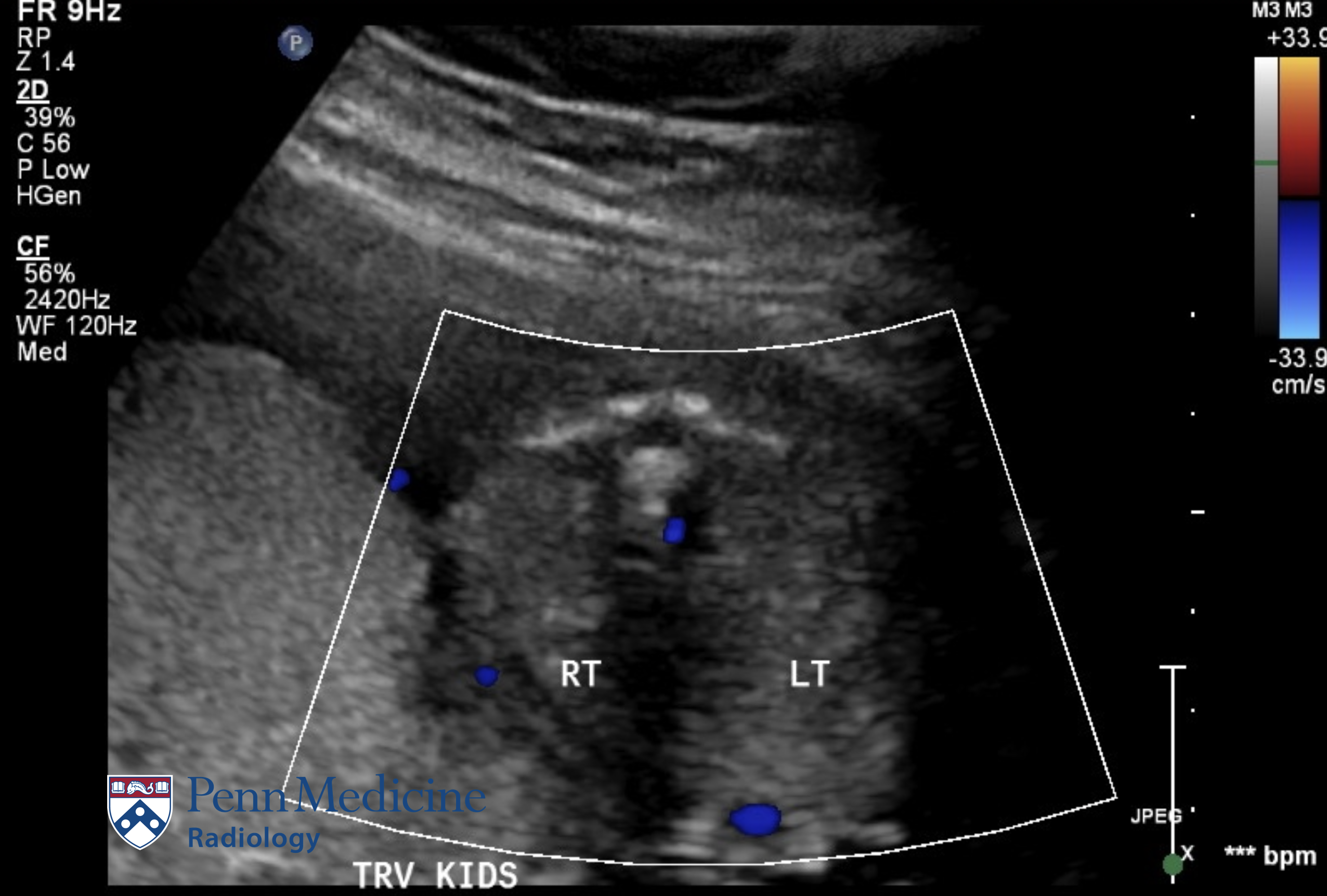 37-week, 0-day-old newborn with adrenal abnormality