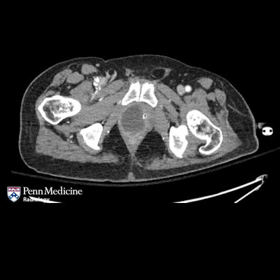 74-year-old man with altered mental status, prior stroke