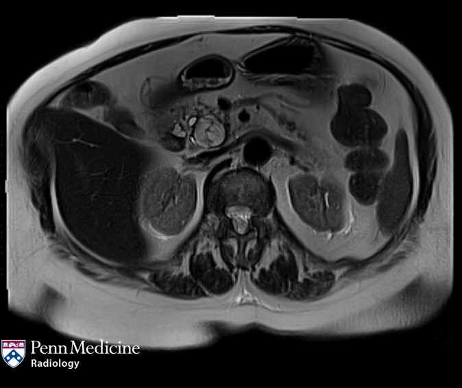 70-year-old woman undergoing follow-up imaging for pancreatic lesion