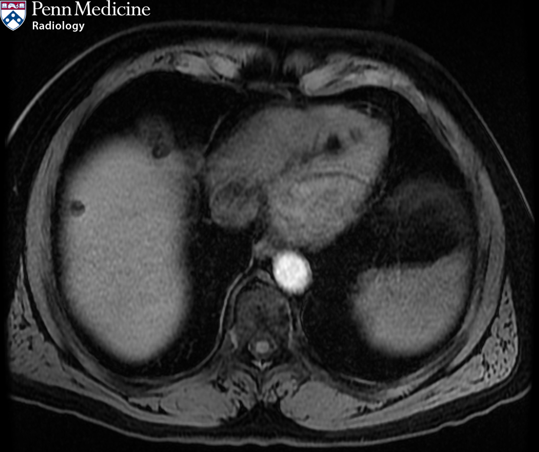 55-year-old man with incidental cardiac finding