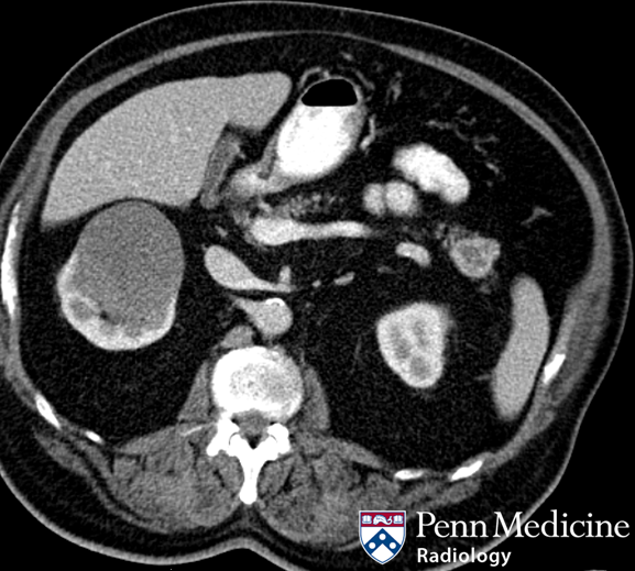 75-year-old man for follow-up of renal mass