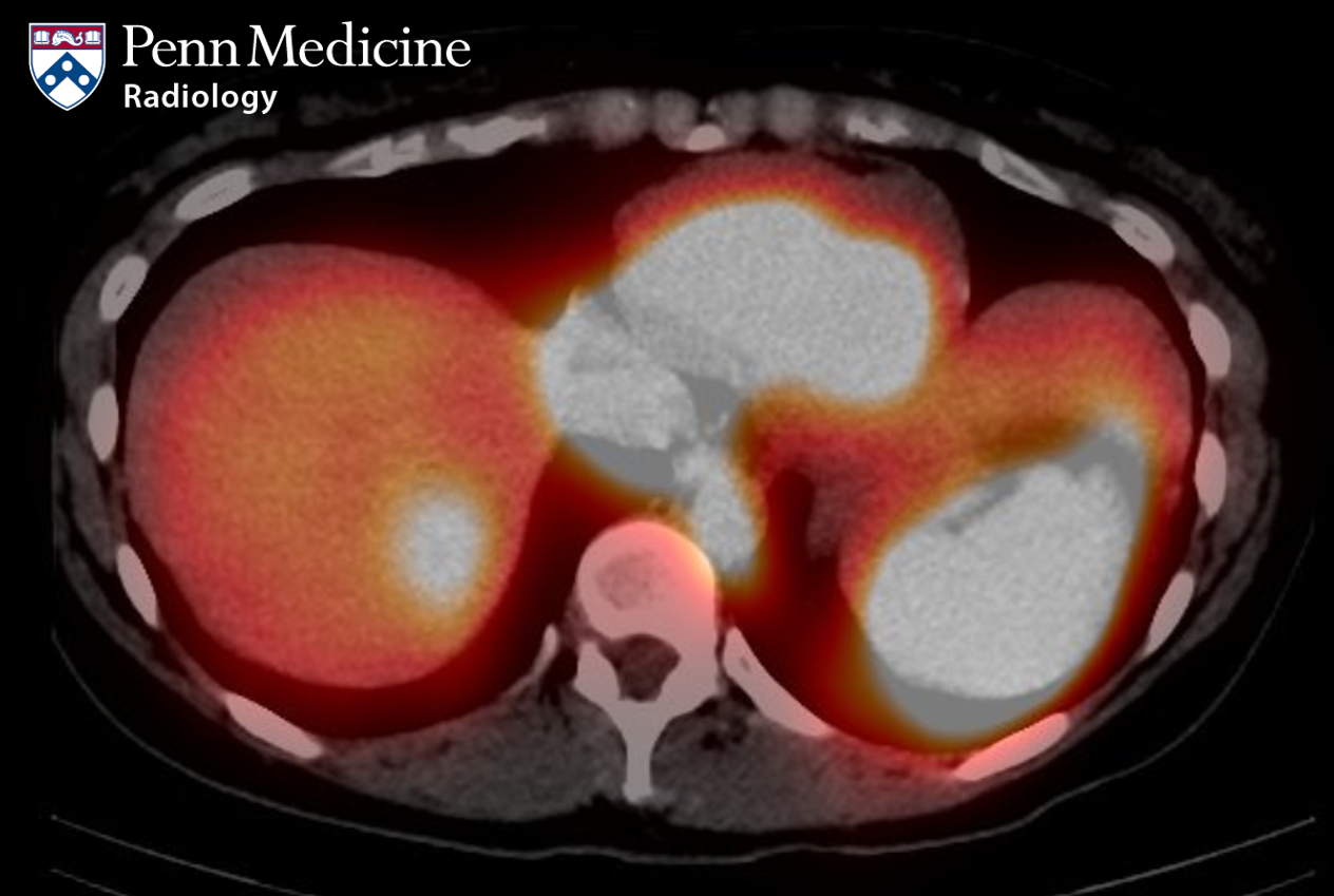 34-year-old woman with an incidental finding