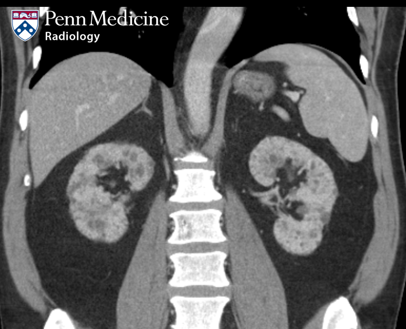 66-year-old man with chronic kidney disease