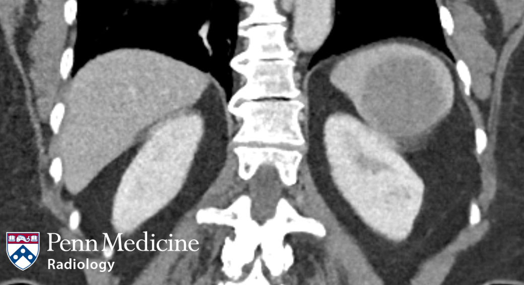 66-year-old woman with a splenic lesion