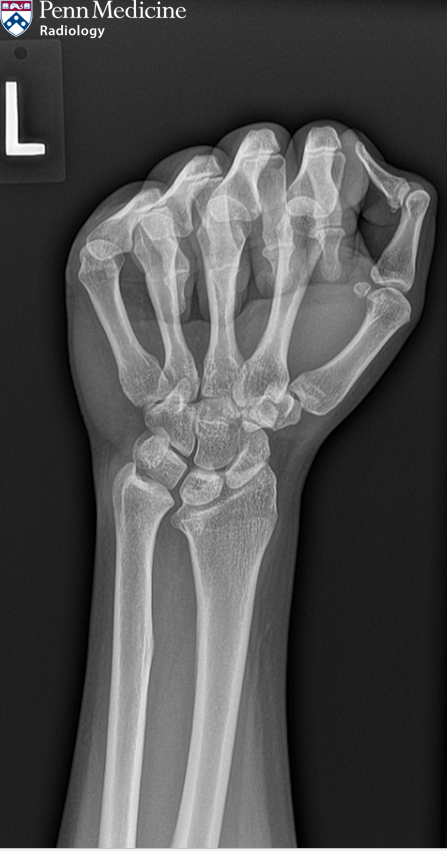 28-year-old woman with left wrist pain