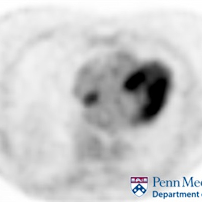 75-year-old woman undergoing restaging