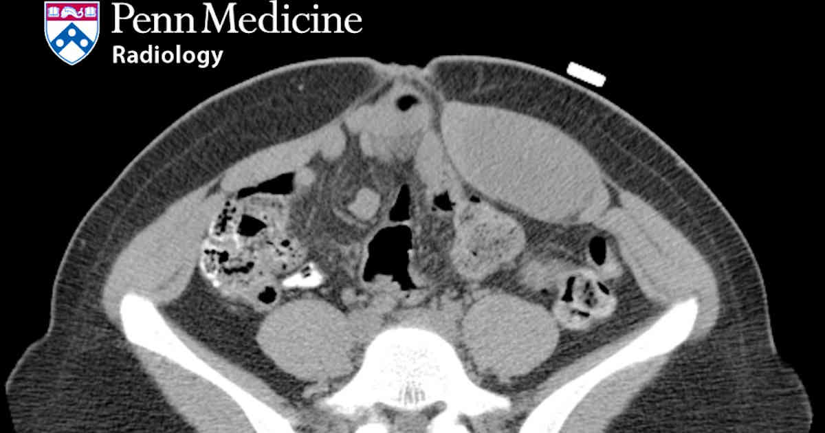 32-year-old woman with palpable abdominal mass