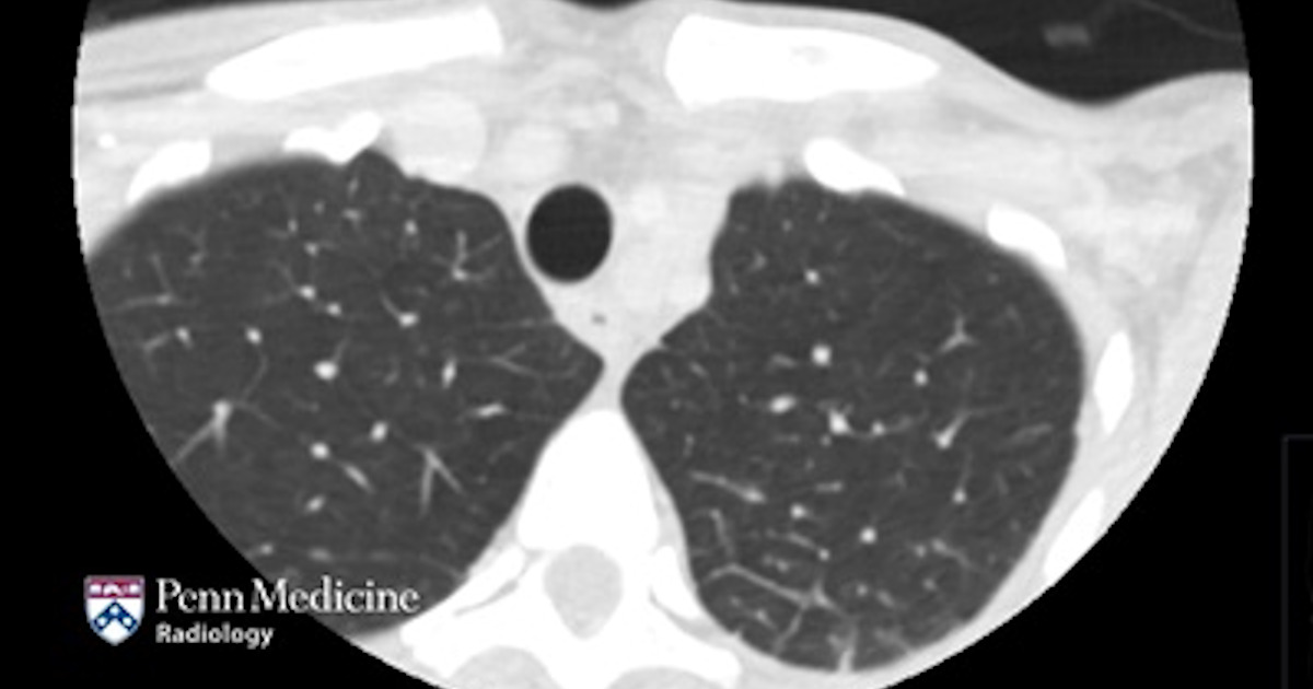 45-year-old woman with neck pain