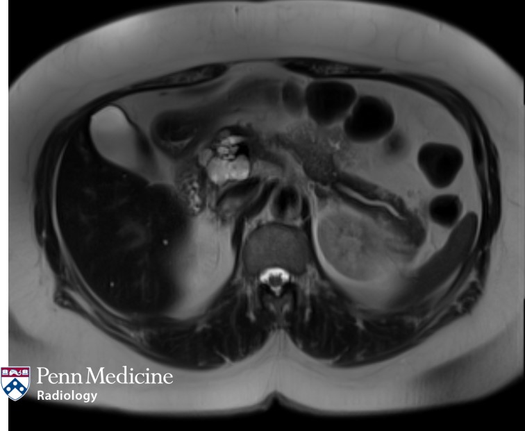 66-year-old woman with incidental pancreatic mass