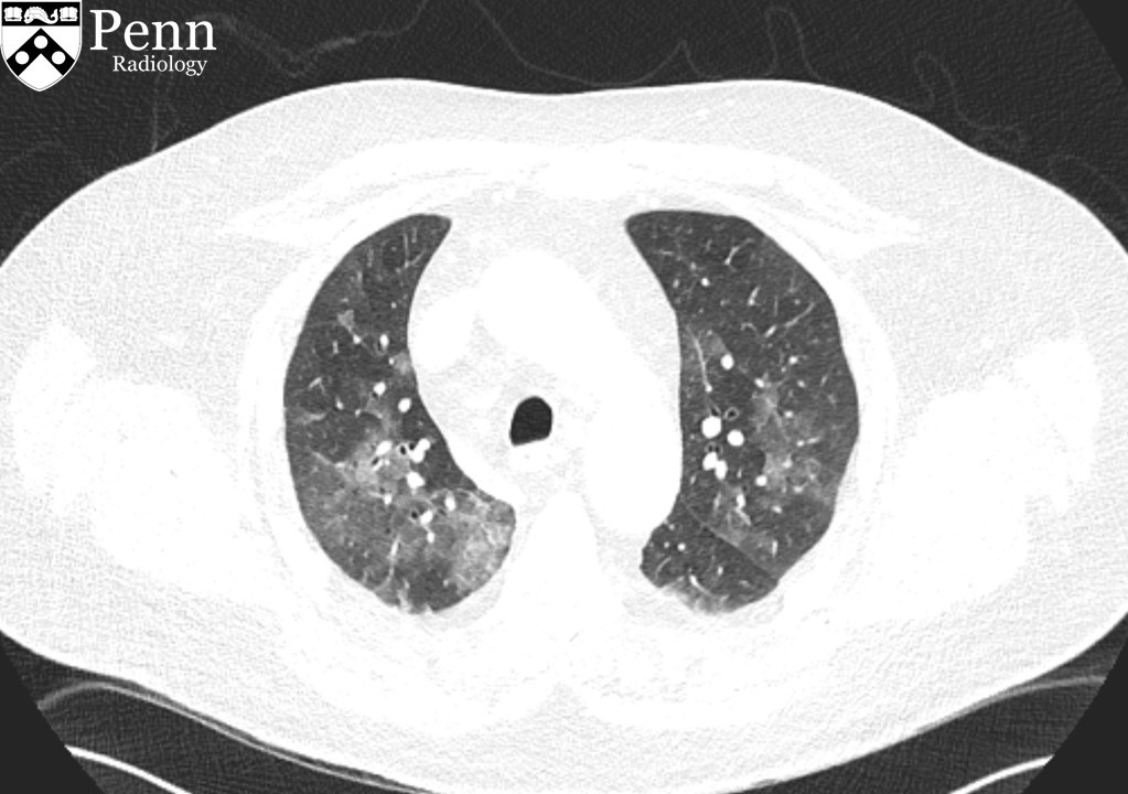 63-year-old man with shortness of breath